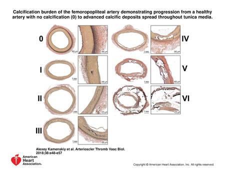 Calcification burden of the femoropopliteal artery demonstrating progression from a healthy artery with no calcification (0) to advanced calcific deposits.