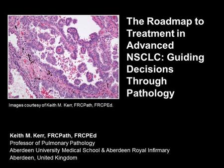 Approximately 85% of lung cancers are classified as non-small cell lung cancer (NSCLC); of these, adenocarcinoma accounts for 50% of cases, and squamous.