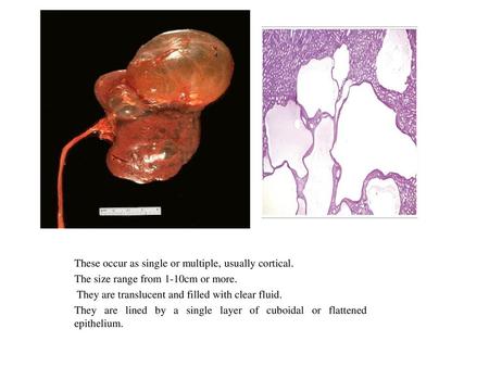 These occur as single or multiple, usually cortical.