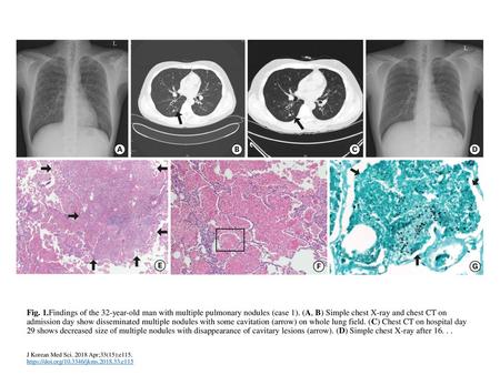 Fig. 1.Findings of the 32-year-old man with multiple pulmonary nodules (case 1). (A, B) Simple chest X-ray and chest CT on admission day show disseminated.