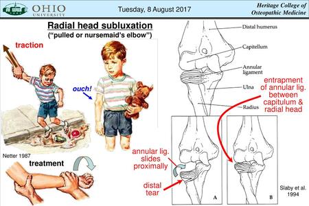 Radial head subluxation (“pulled or nursemaid’s elbow”)