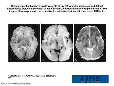 Herpes encephalitis type 2 in a 2-week-old girl