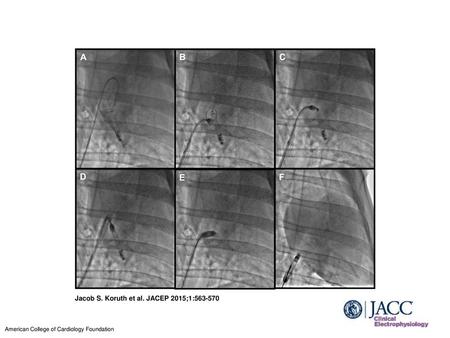 Jacob S. Koruth et al. JACEP 2015;1: