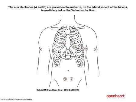 The arm electrodes (A and B) are placed on the mid-arm, on the lateral aspect of the biceps, immediately below the V4 horizontal line. The arm electrodes.