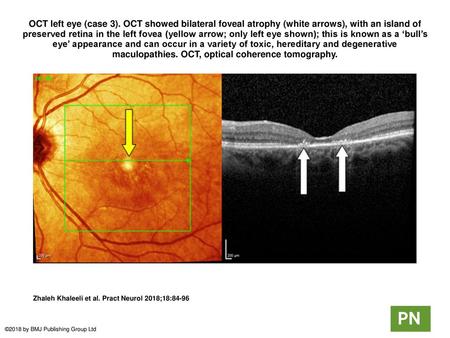 OCT left eye (case 3). OCT showed bilateral foveal atrophy (white arrows), with an island of preserved retina in the left fovea (yellow arrow; only left.