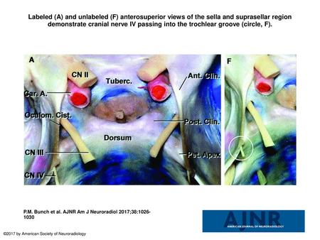 Labeled (A) and unlabeled (F) anterosuperior views of the sella and suprasellar region demonstrate cranial nerve IV passing into the trochlear groove (circle,