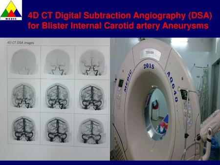 4D CT Digital Subtraction Angiography (DSA)