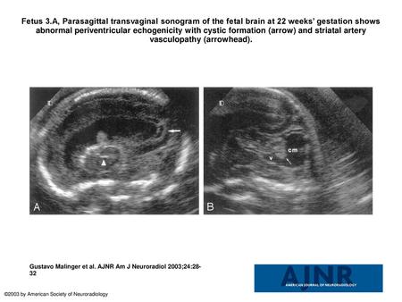 Fetus 3.A, Parasagittal transvaginal sonogram of the fetal brain at 22 weeks’ gestation shows abnormal periventricular echogenicity with cystic formation.