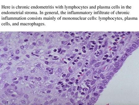 Here is chronic endometritis with lymphocytes and plasma cells in the endometrial stroma. In general, the inflammatory infiltrate of chronic inflammation.