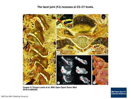 The facet joint (FJ) recesses at C2–C7 levels.