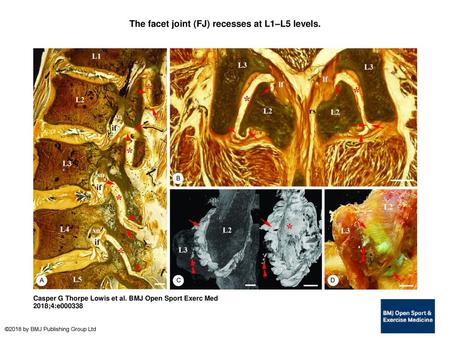 The facet joint (FJ) recesses at L1–L5 levels.