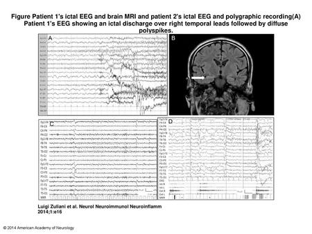 Figure Patient 1's ictal EEG and brain MRI and patient 2's ictal EEG and polygraphic recording(A) Patient 1's EEG showing an ictal discharge over right.