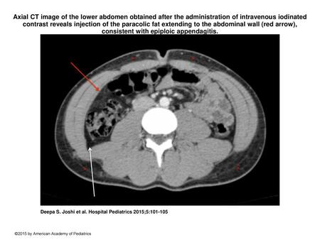 Axial CT image of the lower abdomen obtained after the administration of intravenous iodinated contrast reveals injection of the paracolic fat extending.