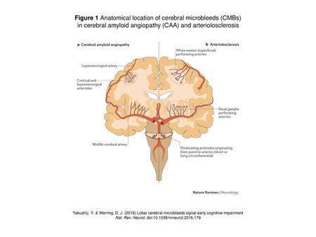 Figure 1 Anatomical location of cerebral microbleeds (CMBs)