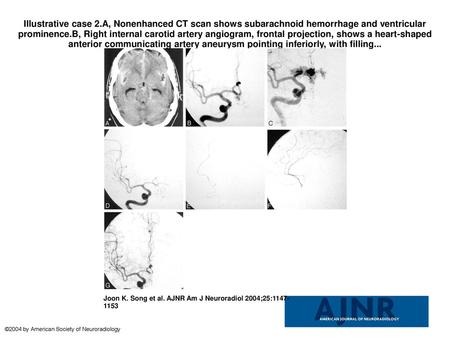 Illustrative case 2.A, Nonenhanced CT scan shows subarachnoid hemorrhage and ventricular prominence.B, Right internal carotid artery angiogram, frontal.