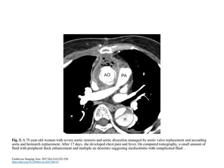 Fig. 5. A 75-year-old woman with severe aortic stenosis and aortic dissection managed by aortic valve replacement and ascending aorta and hemiarch replacement.