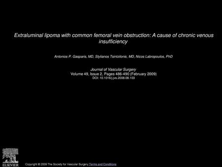 Extraluminal lipoma with common femoral vein obstruction: A cause of chronic venous insufficiency  Antonios P. Gasparis, MD, Stylianos Tsintzilonis, MD,