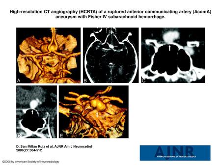 High-resolution CT angiography (HCRTA) of a ruptured anterior communicating artery (AcomA) aneurysm with Fisher IV subarachnoid hemorrhage. High-resolution.