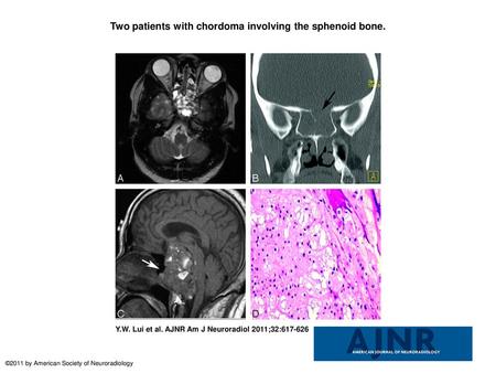 Two patients with chordoma involving the sphenoid bone.