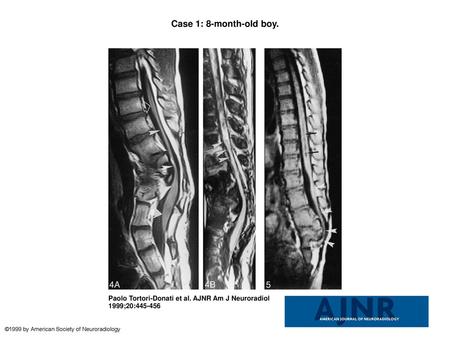 Case 1: 8-month-old boy. Case 1: 8-month-old boy. A and B, Sagittal SE T1-weighted MR image (500/14/2) (A) and 3-mm-thick reformatted sagittal MR image.