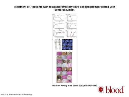 Treatment of 7 patients with relapsed/refractory NK/T-cell lymphomas treated with pembrolizumab. Treatment of 7 patients with relapsed/refractory NK/T-cell.