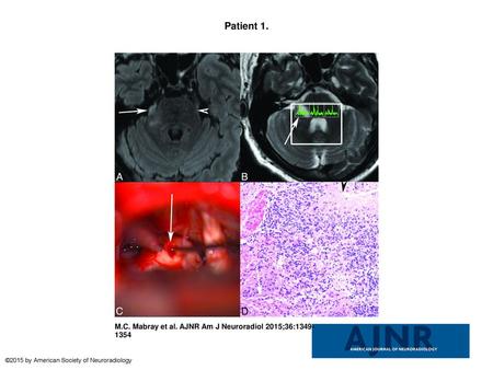 Patient 1. Patient 1. Axial T2 FLAIR (A) MR image demonstrates abnormal T2 FLAIR signal in the right lateral pons extending into the right trigeminal nerve.