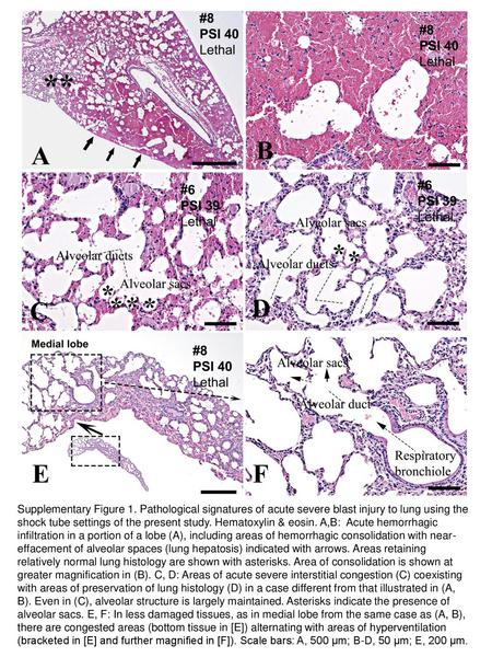 Supplementary Figure 1. Pathological signatures of acute severe blast injury to lung using the shock tube settings of the present study. Hematoxylin &