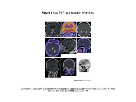 Figure 4 New PET radiotracers in lymphoma