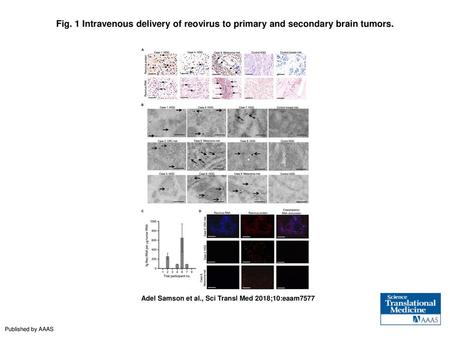 Intravenous delivery of reovirus to primary and secondary brain tumors