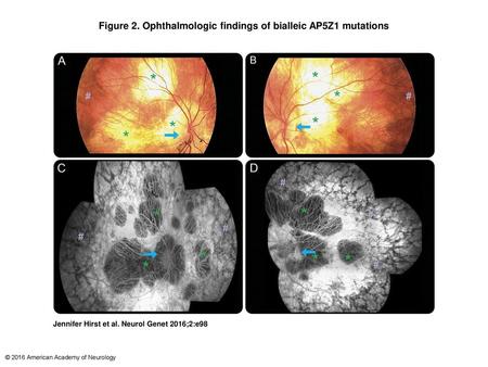 Figure 2. Ophthalmologic findings of bialleic AP5Z1 mutations