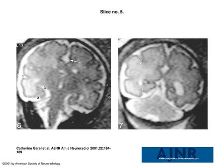 Slice no. 5. Slice no. 5. T2-weighted coronal image (20/9.2/12) at the level of the temporal horns (33 weeks' gestation). Large arrow, cingulate sulcus;