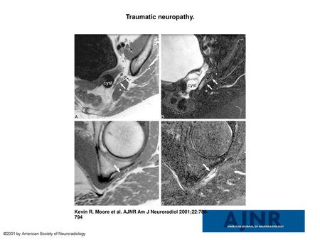 Traumatic neuropathy. Traumatic neuropathy. A, Sagittal oblique plane T1-weighted image (560/10/2), obtained at the level of the piriformis muscle (asterisk),