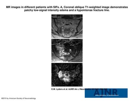 MR images in different patients with SIFs