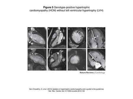 Figure 5 Genotype-positive hypertrophic