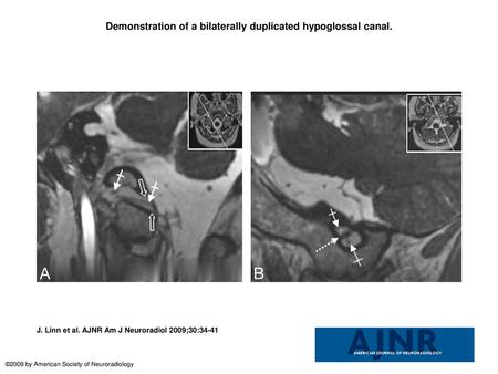 Demonstration of a bilaterally duplicated hypoglossal canal.