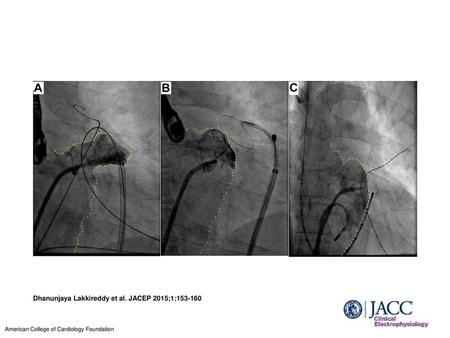 Dhanunjaya Lakkireddy et al. JACEP 2015;1: