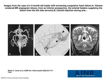 Images from the case of a 3-month-old triplet with worsening congestive heart failure.A, Volume-rendered MR angiogram shows, from an inferior prospective,