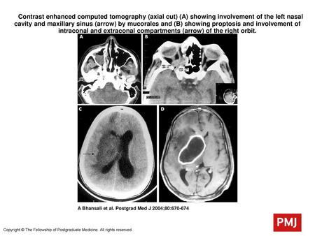  Contrast enhanced computed tomography (axial cut) (A) showing involvement of the left nasal cavity and maxillary sinus (arrow) by mucorales and (B) showing.