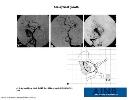 Aneurysmal growth. Aneurysmal growth. A, Pretreatment angiogram of a large, wide-necked, basilar sidewall aneurysm occurring as a mass lesion. This image.