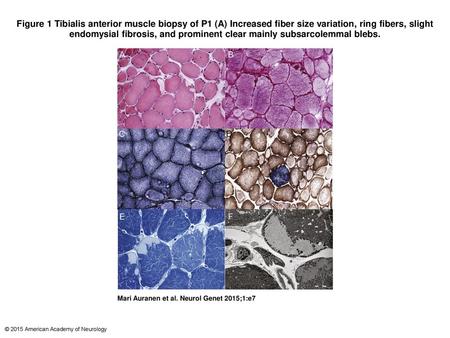 Figure 1 Tibialis anterior muscle biopsy of P1 (A) Increased fiber size variation, ring fibers, slight endomysial fibrosis, and prominent clear mainly.