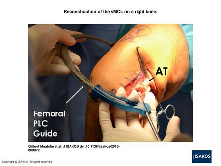 Reconstruction of the sMCL on a right knee.