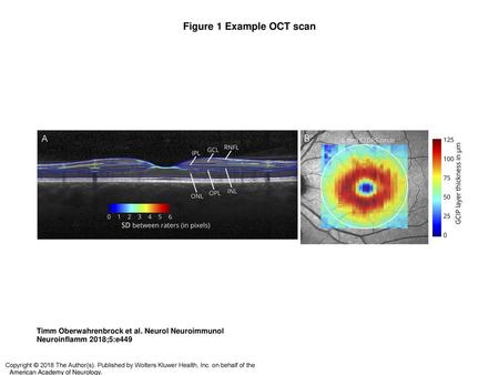 Figure 1 Example OCT scan