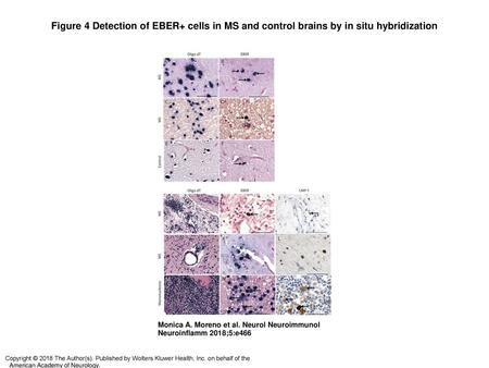 Figure 4 Detection of EBER+ cells in MS and control brains by in situ hybridization Detection of EBER+ cells in MS and control brains by in situ hybridization.