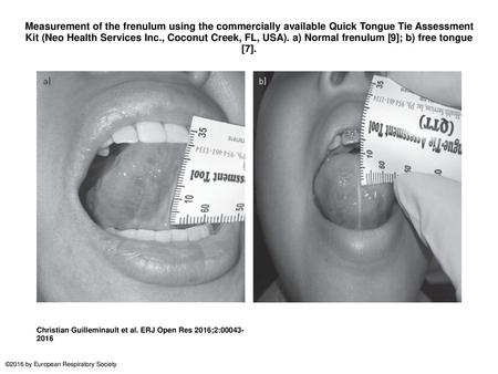 Measurement of the frenulum using the commercially available Quick Tongue Tie Assessment Kit (Neo Health Services Inc., Coconut Creek, FL, USA). a) Normal.