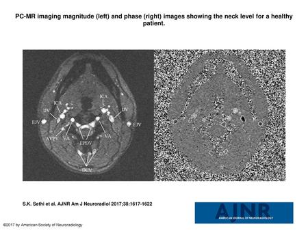 PC-MR imaging magnitude (left) and phase (right) images showing the neck level for a healthy patient. PC-MR imaging magnitude (left) and phase (right)