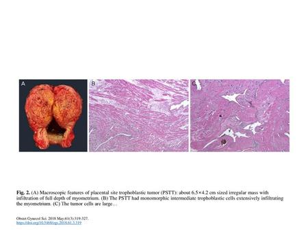 Fig. 2. (A) Macroscopic features of placental site trophoblastic tumor (PSTT): about 6.5×4.2 cm sized irregular mass with infiltration of full depth of.