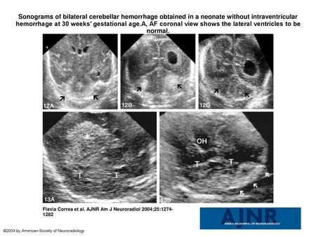 Sonograms of bilateral cerebellar hemorrhage obtained in a neonate without intraventricular hemorrhage at 30 weeks’ gestational age.A, AF coronal view.