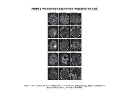 Figure 3 MRI findings in opportunistic infections of the CNS