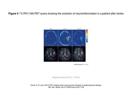 Figure 4 11C-PK11195-PET scans showing the evolution of neuroinflammation in a patient after stroke Figure 4 | 11C-PK11195-PET scans showing the evolution.