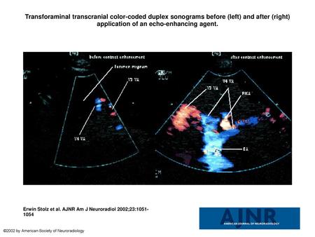 Transforaminal transcranial color-coded duplex sonograms before (left) and after (right) application of an echo-enhancing agent. Transforaminal transcranial.